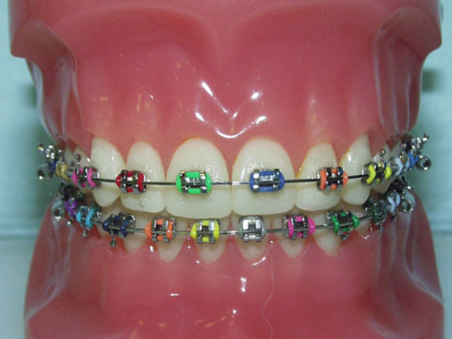 Got first set of braces.