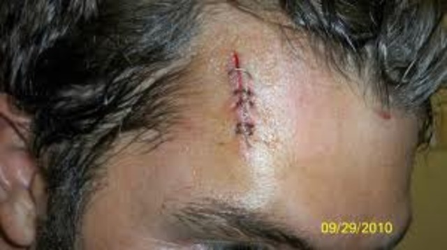 First time i got stitches