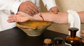 Timeline: Evolution of Bloodletting