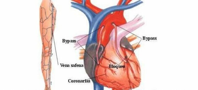Invención del bypass