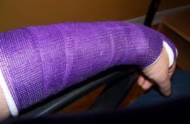 I broke my right arm.