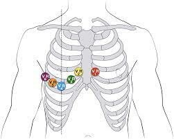 Right Sided Precordial Lead