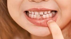 Cau la meva primera dent