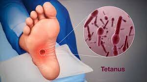 First Attempts at Tetanus Antitoxin