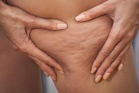 Wrinkles and Cellulite