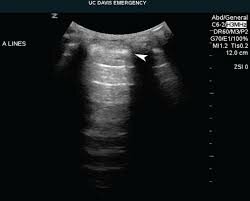 Lung and General Sonography