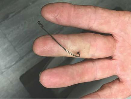 I got a fishhook in my foot
