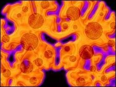 Avances tecnológicos para  detectar la enfermedad de alzheimer  años antes de que aparezcan los síntomas.