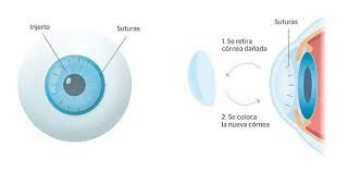 Queratoplastia