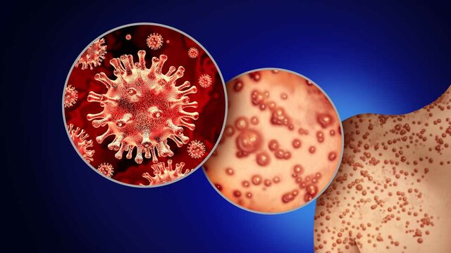 2022 - Viruela Símica o del Mono