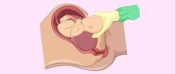 Hipoxia Perinatal