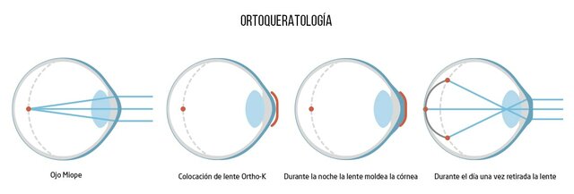 La FDA aprueba la ortoqueratología de un día para otro.