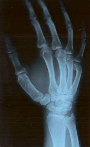 Hand Surgery