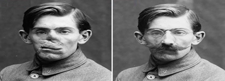 Prótesis Primera guerra mundial