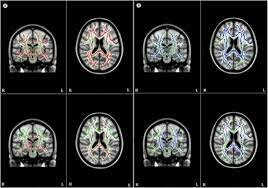 Se empiezan a utilizar técnicas de evaluación más modernas, como la neuroimagen y la genética.