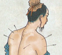 Acupuncture