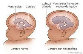 Anomalías con hidrocefalia