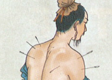 Acupuncture