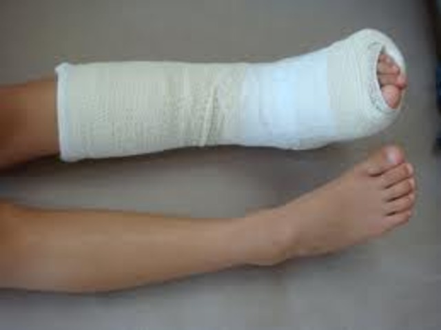 Brian was riding a bike, ran in to a car, and broke his ankle