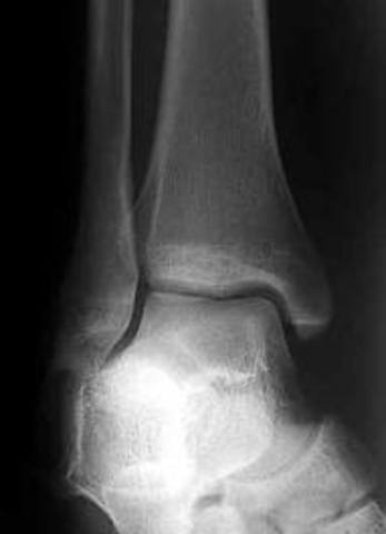 Brian broke his ankle