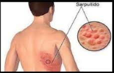 Articulo sobre cuadro clínico de la desnutrición en el sureste de mexico