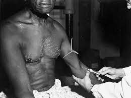 Tuskegee Syphilis Study Begins