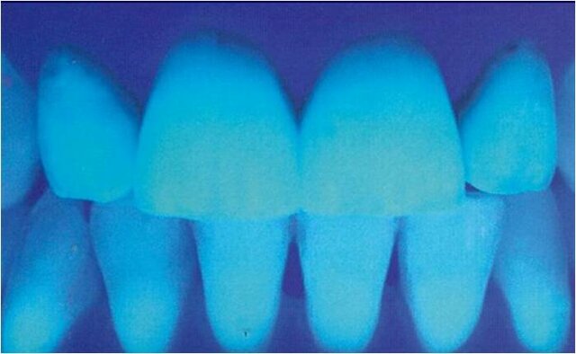 Color floreciente a los dientes Inicios de los 30
