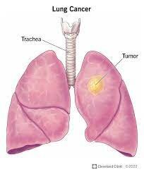 Disease, Lung Cancer.