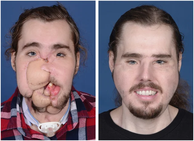 Face Transplants
