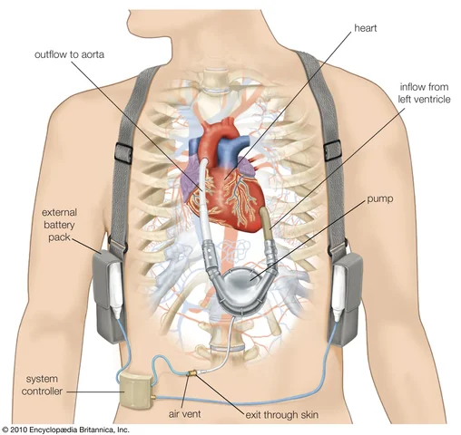 First Artificial Heart
