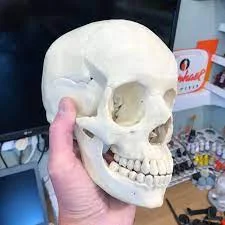 Surgeons in Netherlands used 3D printed skull in a complete skull transplant