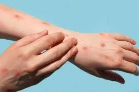 smallpox