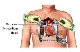 open heart surgery