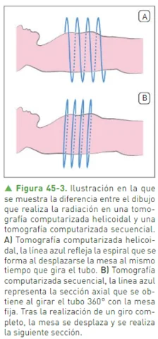 1987 Tomografia secuencial frente a tomografía helicoidal