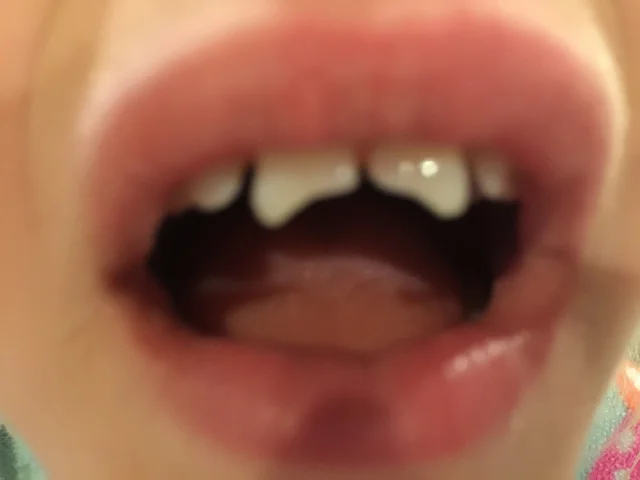 Knocked Half of my Front Teeth out