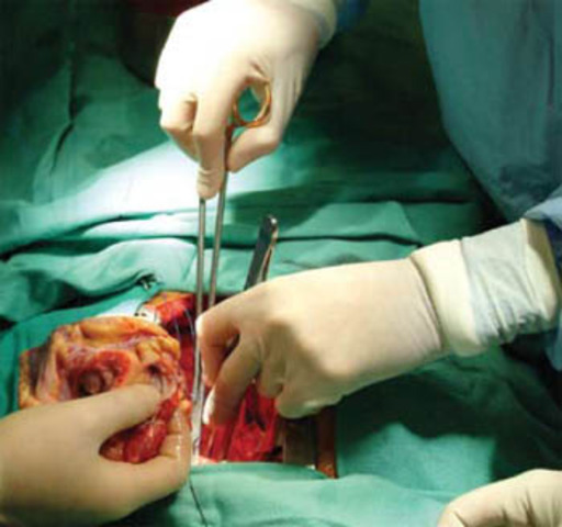 First Heart Transplant