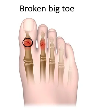 broke my toe