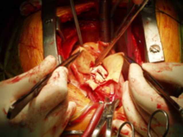 Doctor Christian Bernard completes the first successful heart transplant.