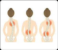 Scoliosis