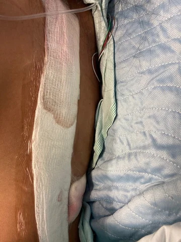 Second surgery