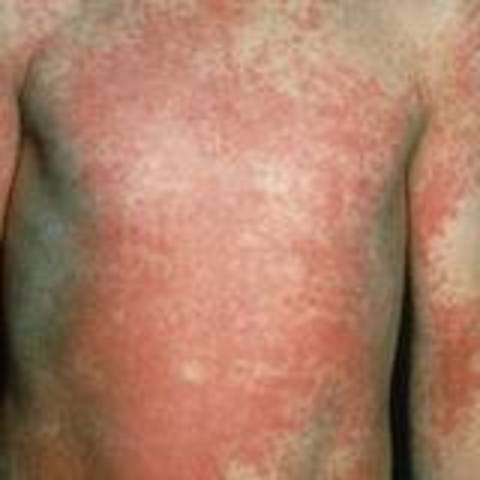 JFK Contracts Scarlet Fever