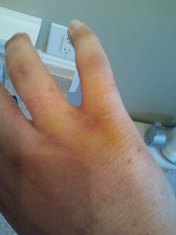 Punched a wall and Broke my hand