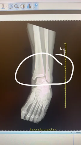 Ankle Injury...