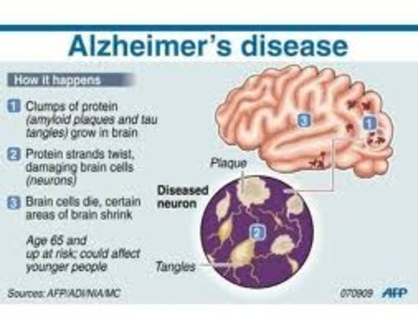 alzheimer's disease