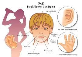 Fetal Alcohol Syndrome Surveillance Network II