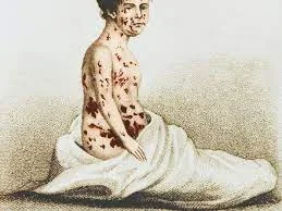 smallpox