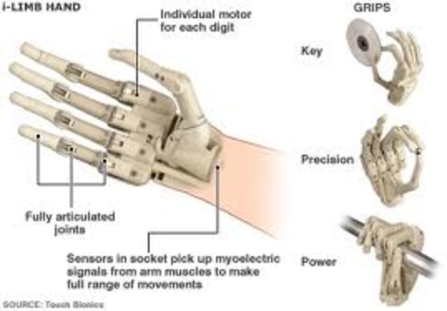 Bionic Hand Transplant