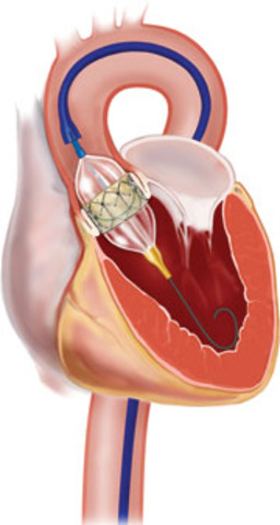 Transcatheter Aortic Valve Replacement