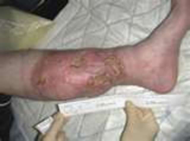 Mickey Mantle gets Osteomyelitis