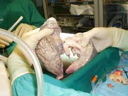 Noiz izan zen biriketako lehen transplantea ?